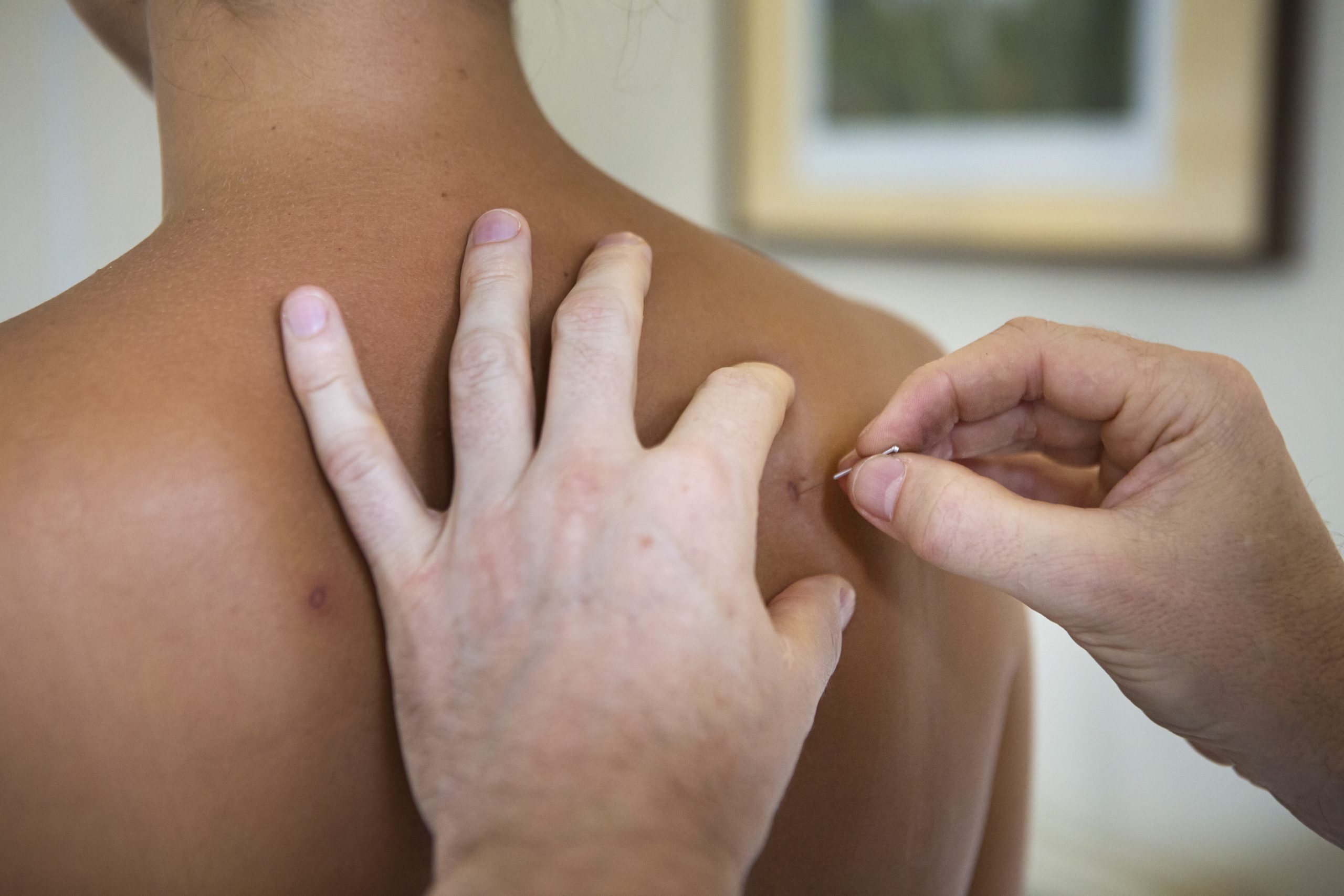Acupuncture needle being inserted into acupoint BL-43 rich for the vitals gao huang shu 膏肓俞