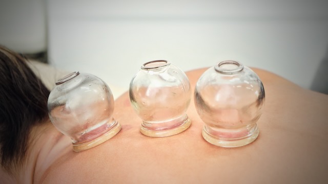 Cupping with glass cups on the Bladder channel